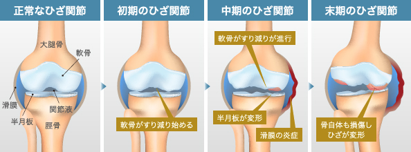 症例　膝痛２