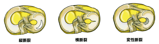 症例　ひざ痛　半月板損傷２