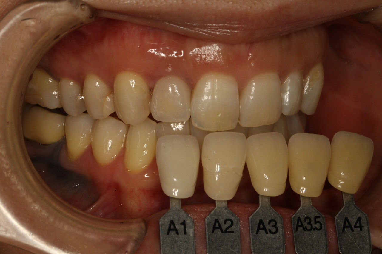 オールセラミックス 歯 オールセラミックのケース - オールセラミック専門ページ