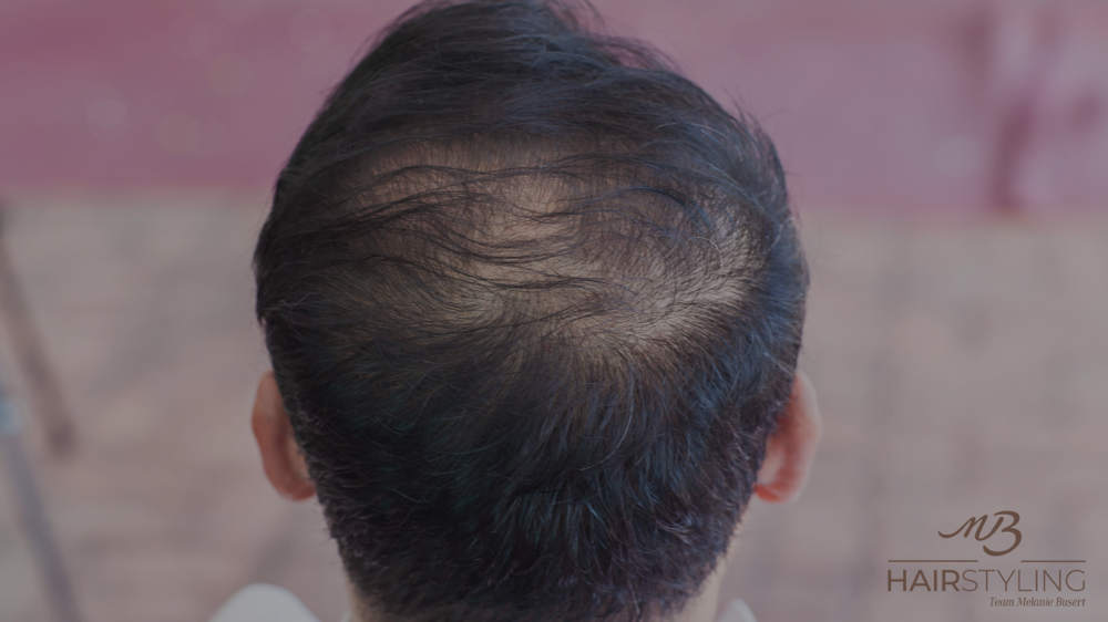 Haarausfall bei Männer, Haartransplantation NRW, haarausfallexperte, yelasai, kopfhautexperte, kopfhautanalyse, kopfhautbehandlung, mikroneedling kopfhaut, Haarausfallexperte Münster, Kopfhautexperte Münster, Kopfhautexperte Ahaus, Kopfhautexperte Legden,