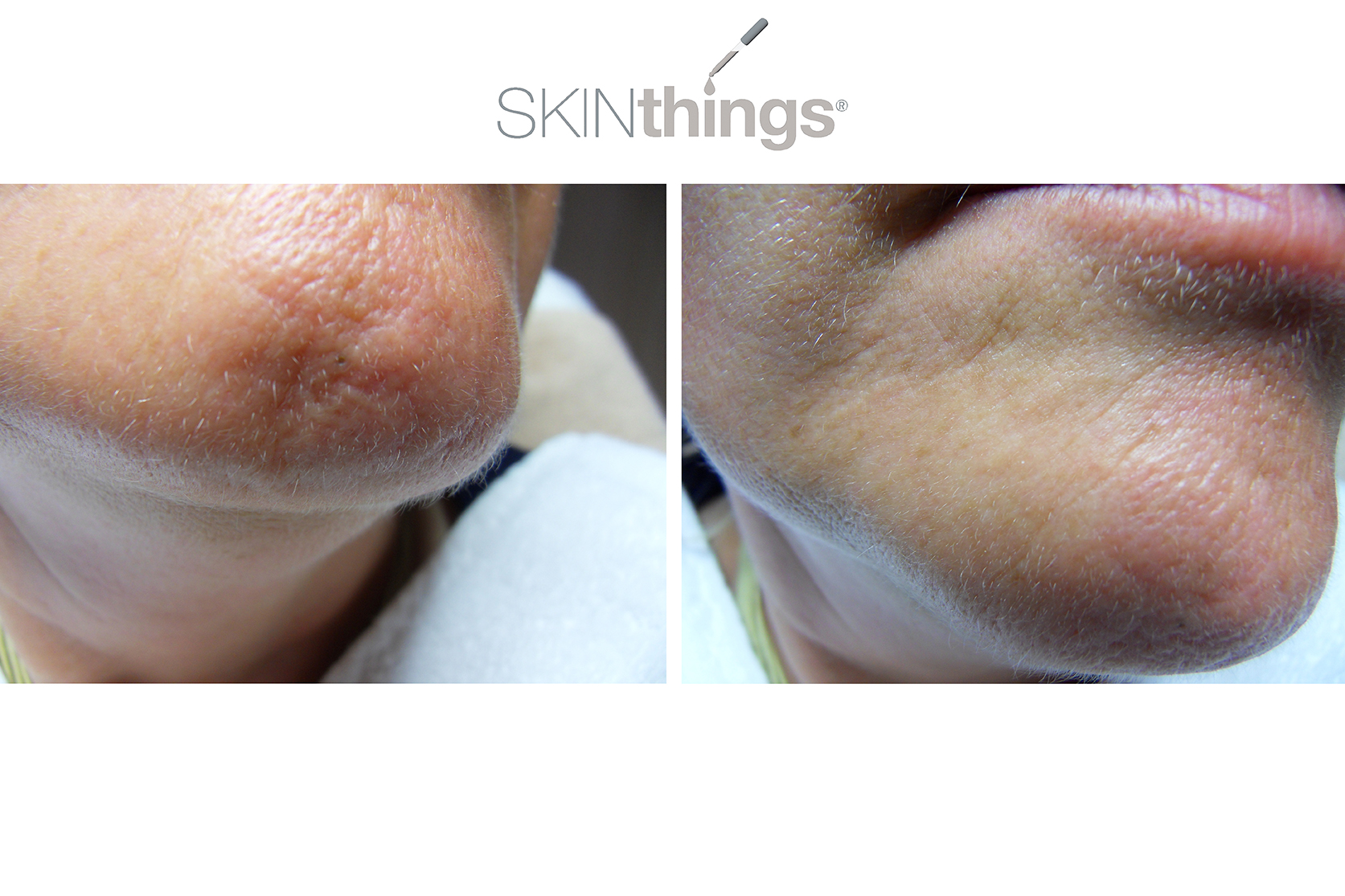 Microneedling bei skinplace in Freising