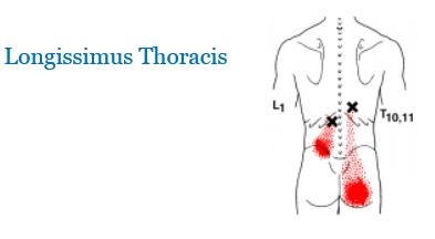 Trigger points ou points gâchette