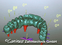 CAD/CAM - Brücke auf Implantaten in Exocat am Bildschirm modelliert