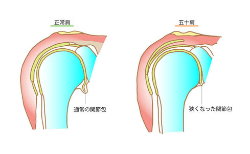 五十肩