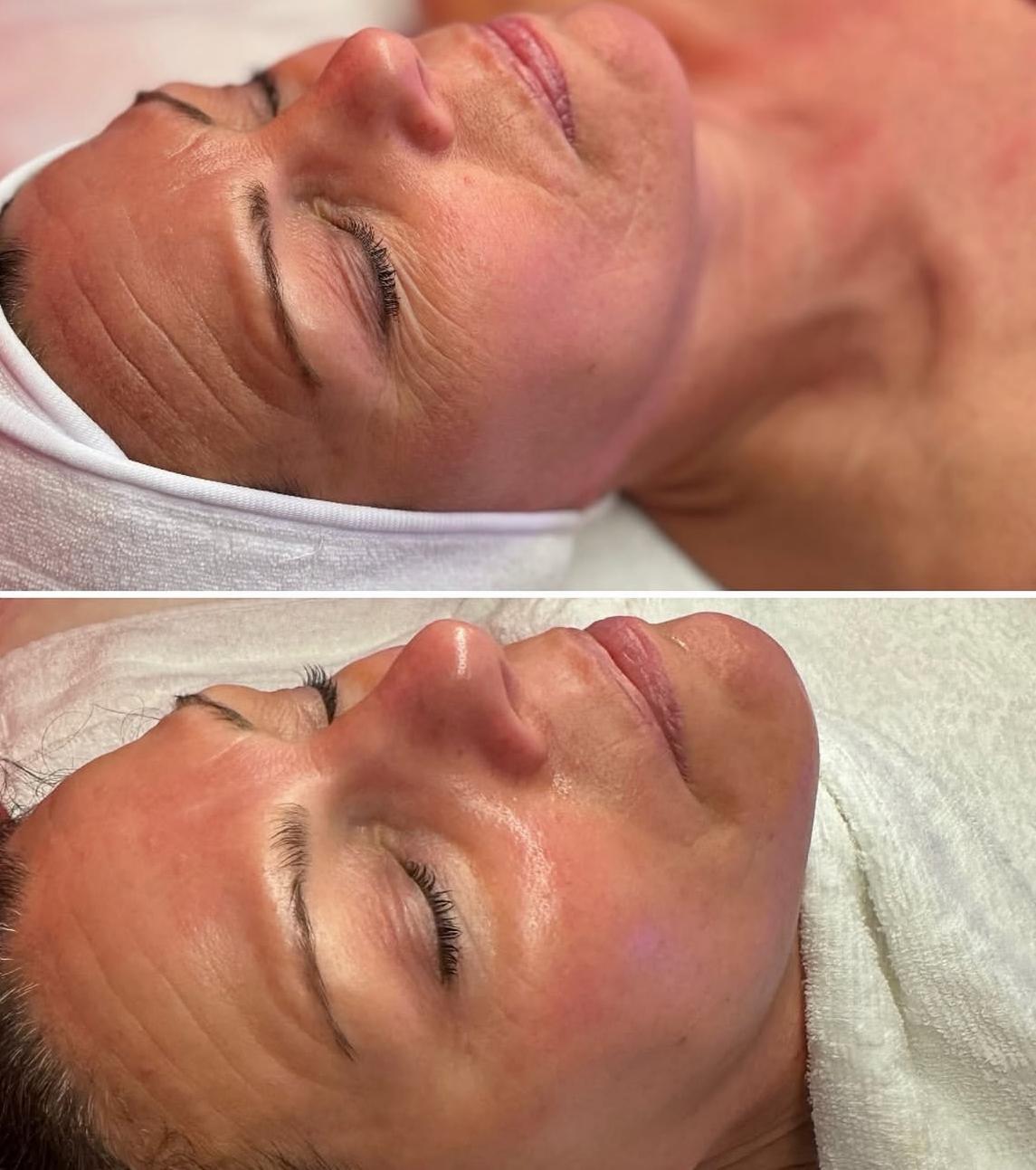 V-Lift Behandlung Aktion
