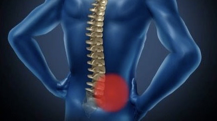 腰痛　トリガーポイント　鍼　鍼灸　筋膜　痛み　松戸　脊柱管狭窄