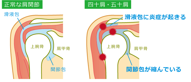 松戸　肩の痛み　鍼　リハビリ　治療