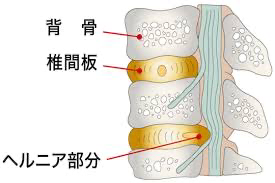 肩こり　鍼　松戸　鍼灸院　トリガーポイント　頭痛　筋膜