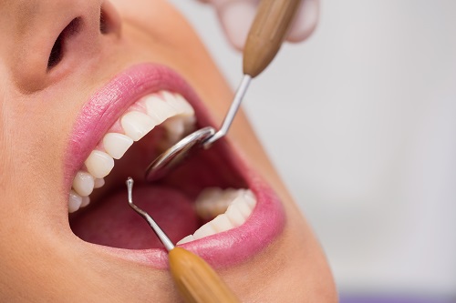 Unlocking the Secrets of Root Canal Therapy: A Definitive Guide