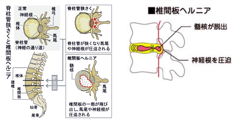 仕事 ヘルニア 頚椎 休む 椎間板 [mixi]今仕事休んでる方いますか?