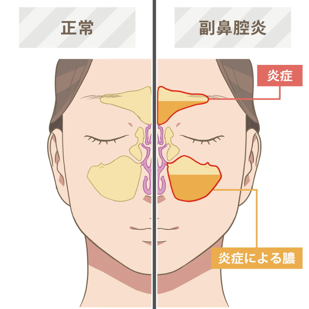●副鼻腔炎　「99％手術は避けられない」と言われた　東京都小平市