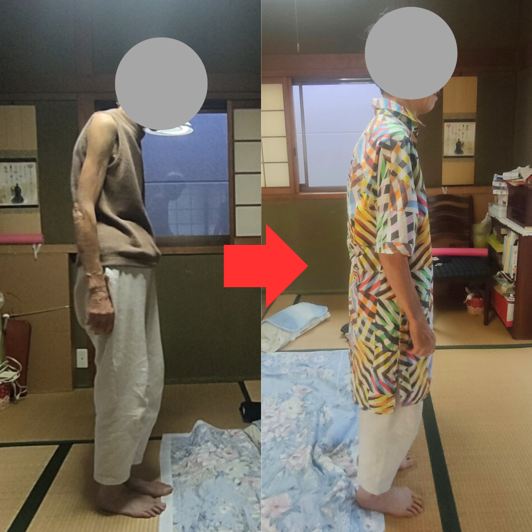 ●姿勢改善　さぼり筋を鍛えると、長年の猫背が改善した　大阪市