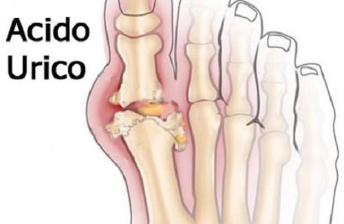 dieta per acidi urici e colesterolo