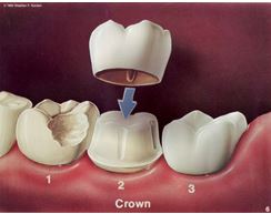 Dental bridge and crown applied in Boone