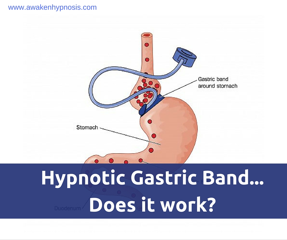 Hypnotic Gastric Band Does it work? Awaken Hypnosis & Coaching
