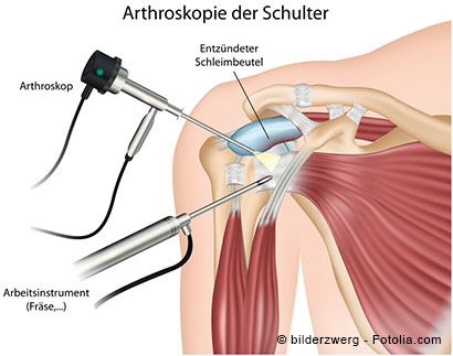 Schematische Darstellung der Arthroskopie der Schulter