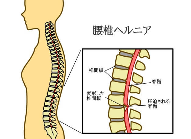 腰椎ヘルニアについて