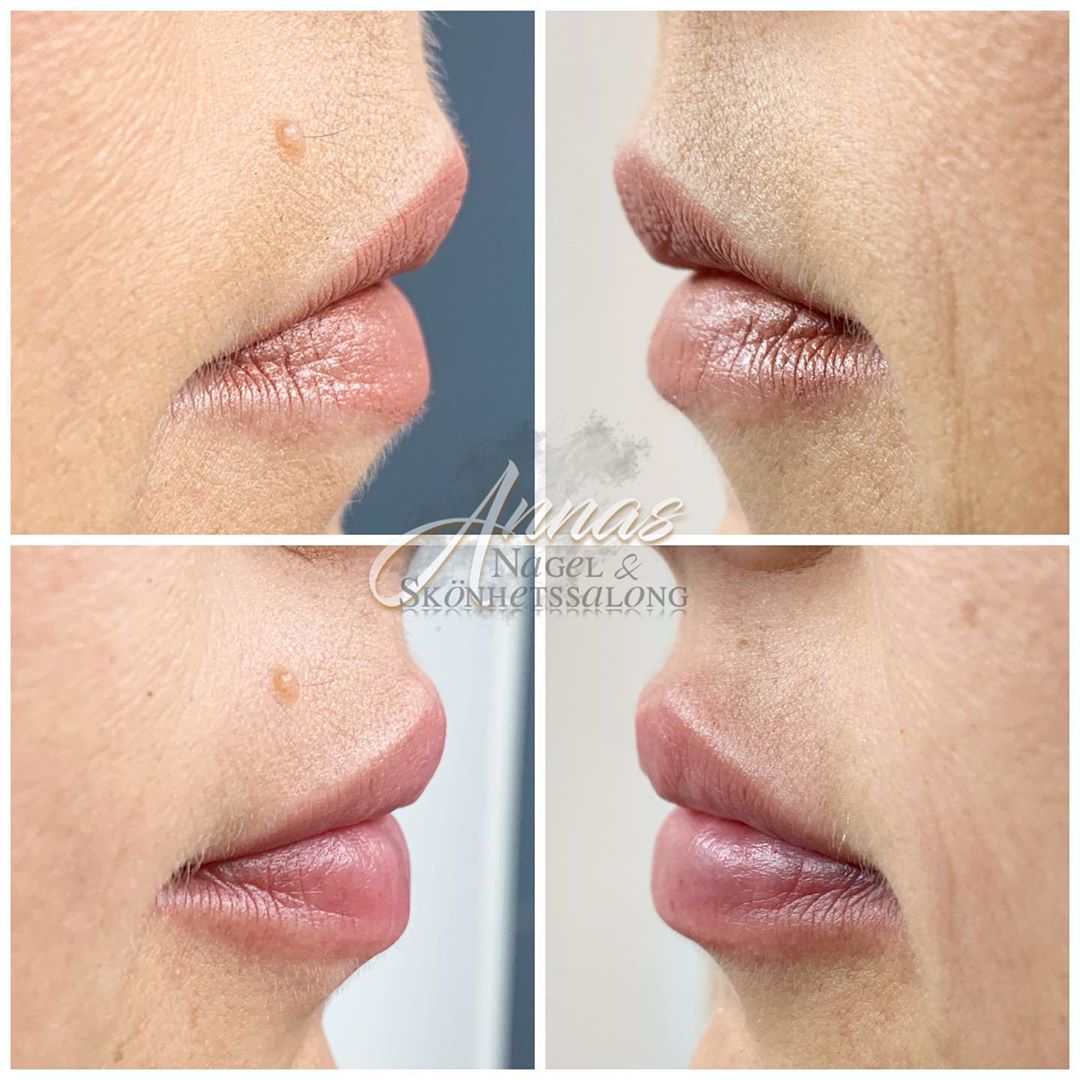 YAVU IRI medical pen Lyxeriet Skönhet & Hälsa i Enköping