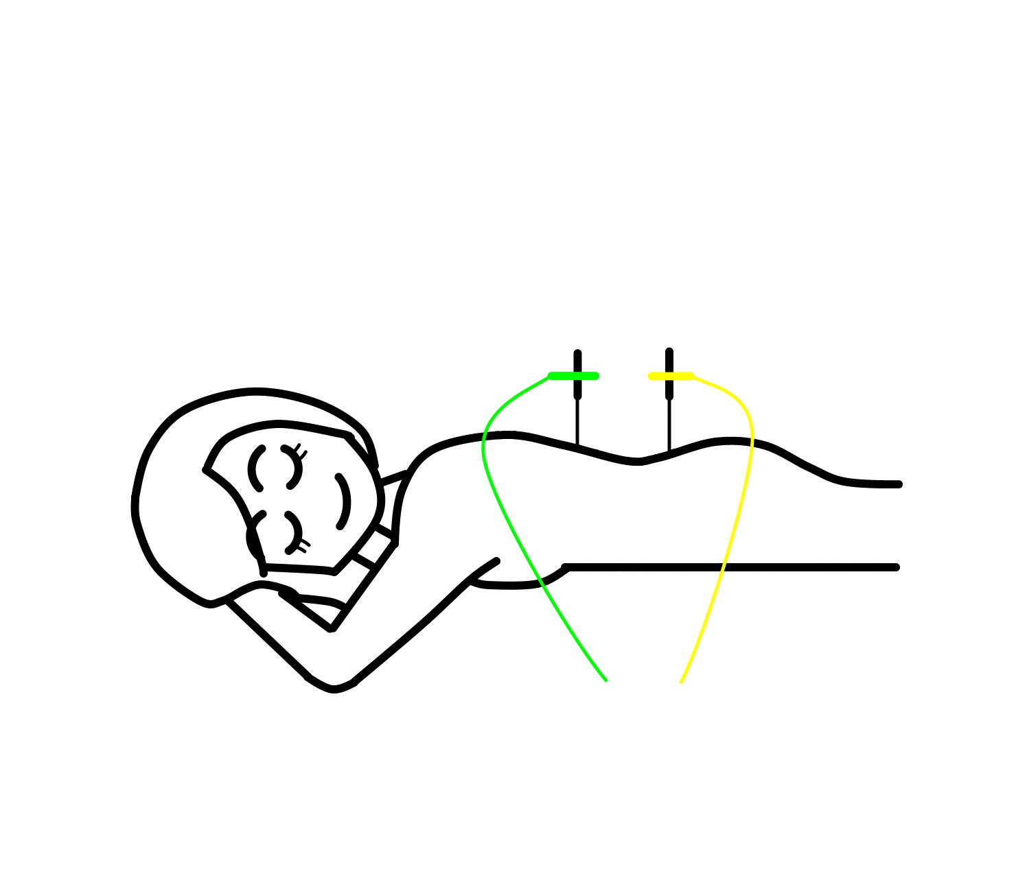 腰痛に鍼灸③