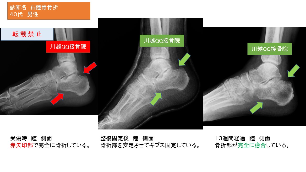 踵の骨折 手術しない！骨折専門 川越QQ接骨院