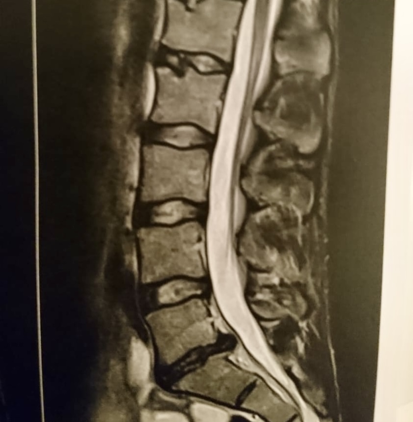 Ärztliche Abklärung Gründliche Untersuchung, Sichtung der MRT-Bilder, klare Diagnose und Empfehlung bei Bandscheibenvorfall 