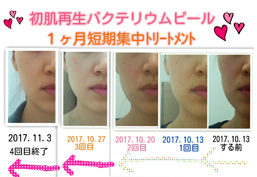 マジョールバクテリウムピール新品