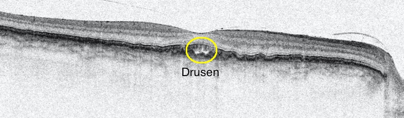 Picture taken in April 2014 showing the druse in my right eye.