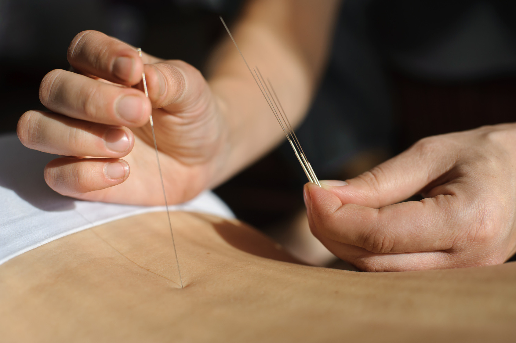 L'acupuncture accompagne la grossesse - Maternité d'Orsay