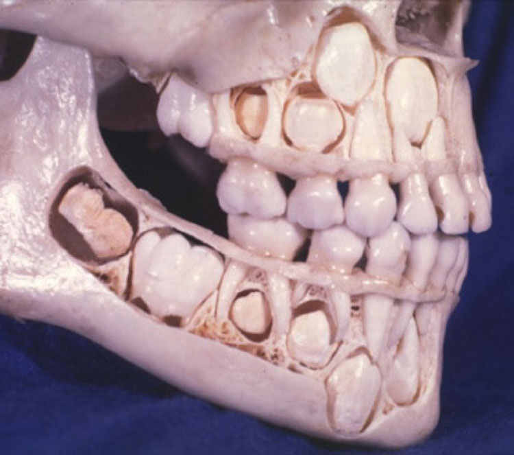 Cráneo de niño con dientes de leche