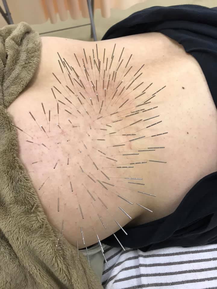 腰のルート治療
