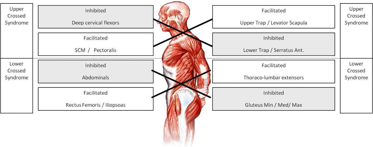 The Domino Affect Of Bad Posture The Whitchurch Clinic Weakness of the deep abdominal muscles ventrally crosses with weakness of the. the domino affect of bad posture the