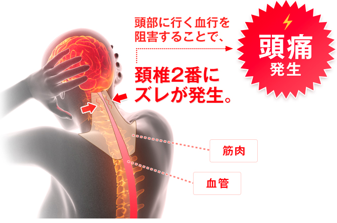 頭部に行く血行阻害することで頭痛が発生　頸椎２番にズレが発生。