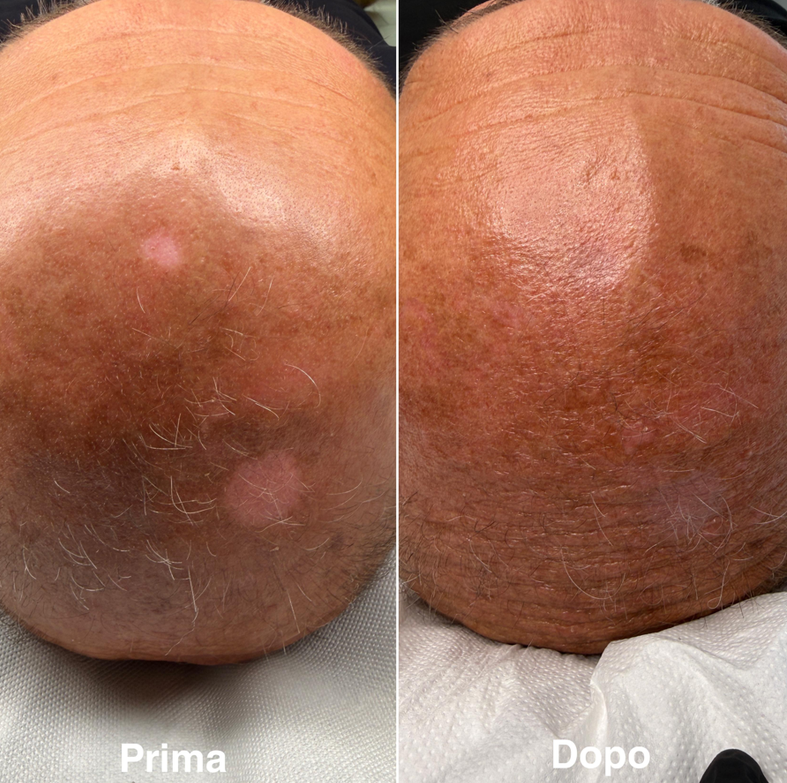 dermopigmentazione paramedicale discromie vitiligine