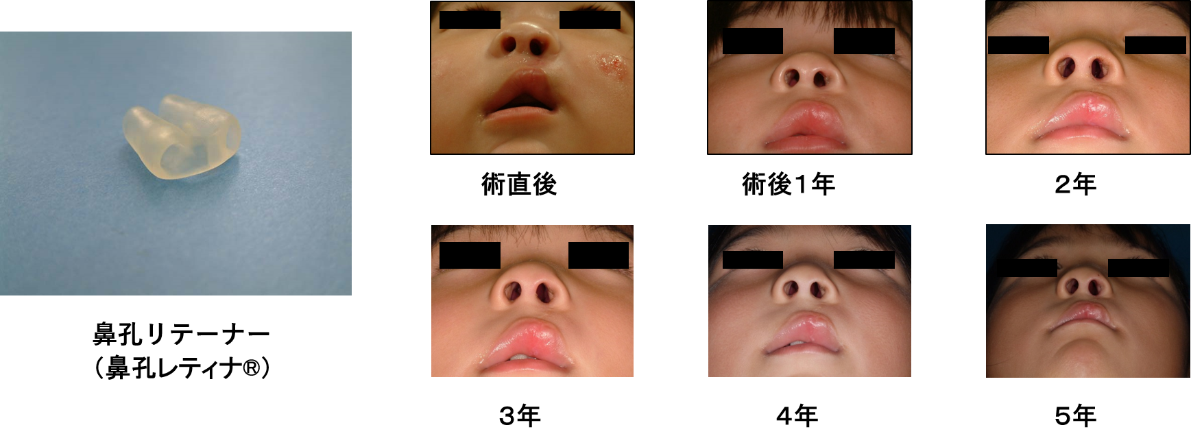 鼻孔レティナ No.7 一般鼻孔レティナ一対タイプ スタンダードSize No. 7