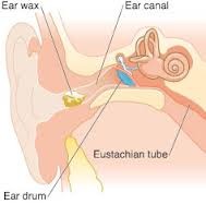 Diagram of wax in the ear canal.