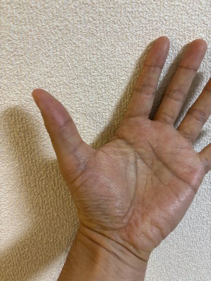 朝起きると指が固まる…もしかしてばね指？知っておきたい初期症状