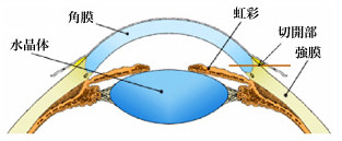 白内障日帰り手術