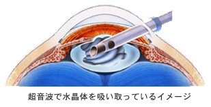 白内障日帰り手術