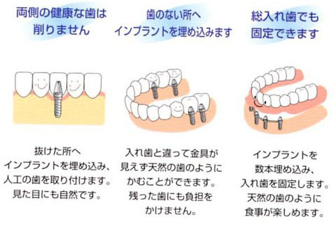 インプラント治療