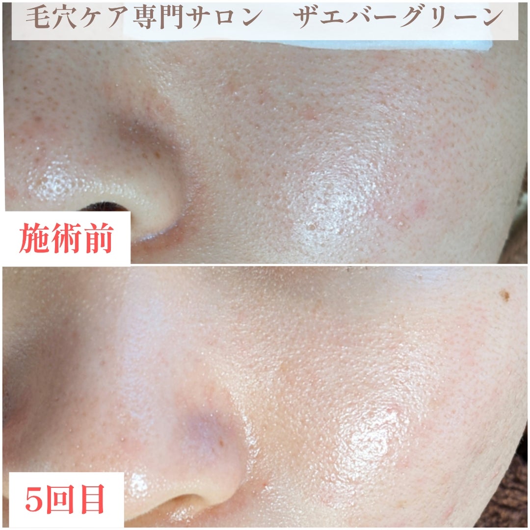 【毛穴ケア】これ以上何をしたらいいか分からない