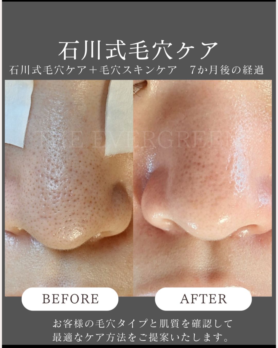 毛穴が小さくなったと言われた！
