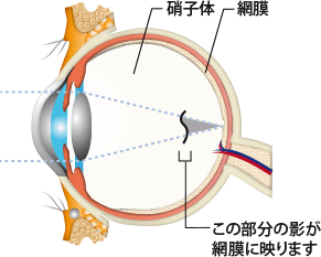 飛蚊症は、眼の中央の硝子体が加齢などで、変性、出血、炎症などが原因で起こります。