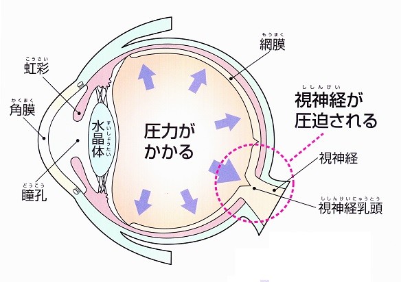 緑内障は、眼圧によって視神経が傷つき、視野が欠けていき、失明する眼の病気です。