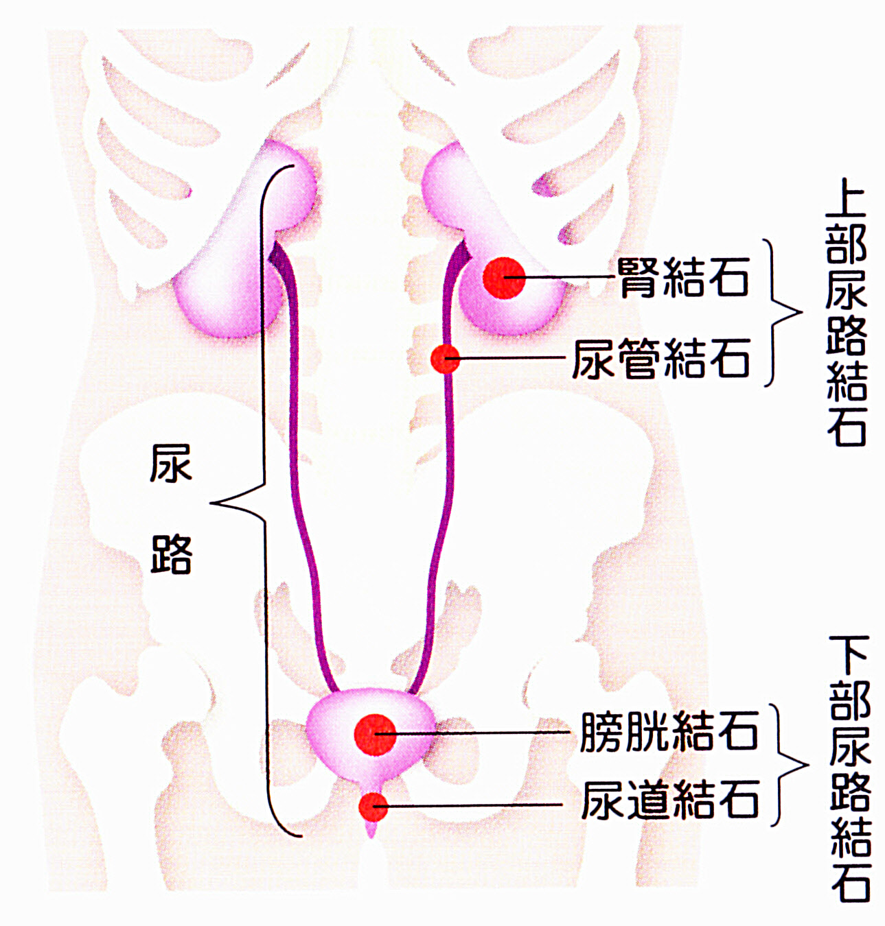 特集」 尿路結石の再発が怖い!? - 土屋薬品MEDIOUSS 特集」 尿路結石の再発が怖い!? - 土屋薬品MEDIOUSS