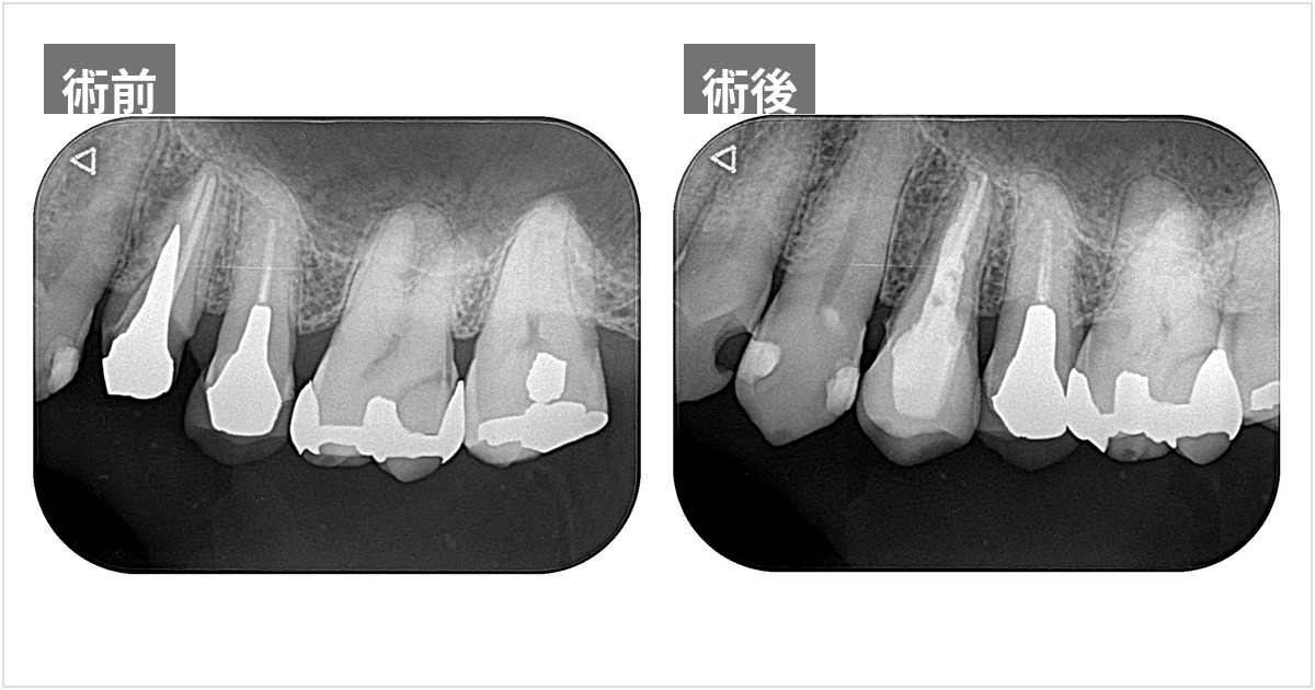 穿孔の封鎖で歯の保存に成功した症例