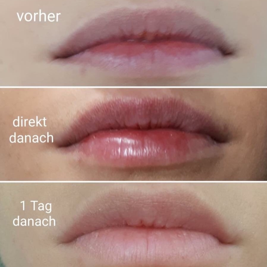 Lippenaufpolsterung