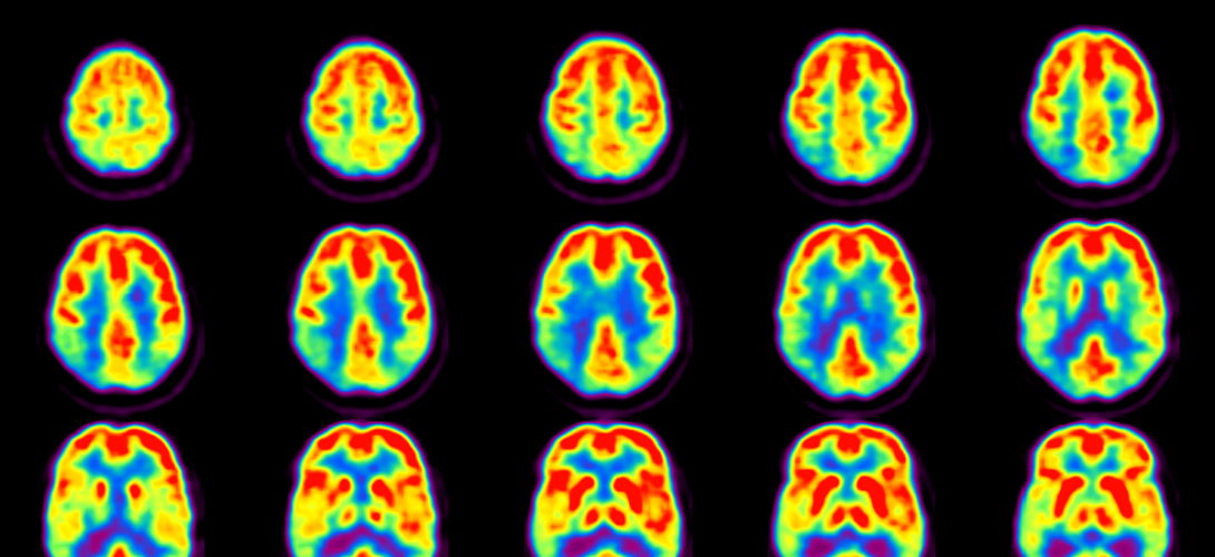 PET (Positron Emission Tomography) Scan