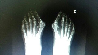 Radiografía de juanetes, durante estudio prequirúrgico