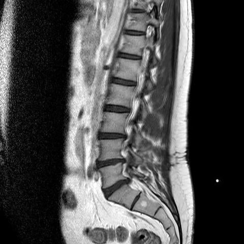 Bandscheiben Vorfall Physio