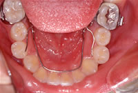 外から見えない矯正